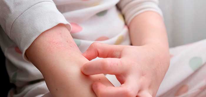 Cuidados del eczema en niños